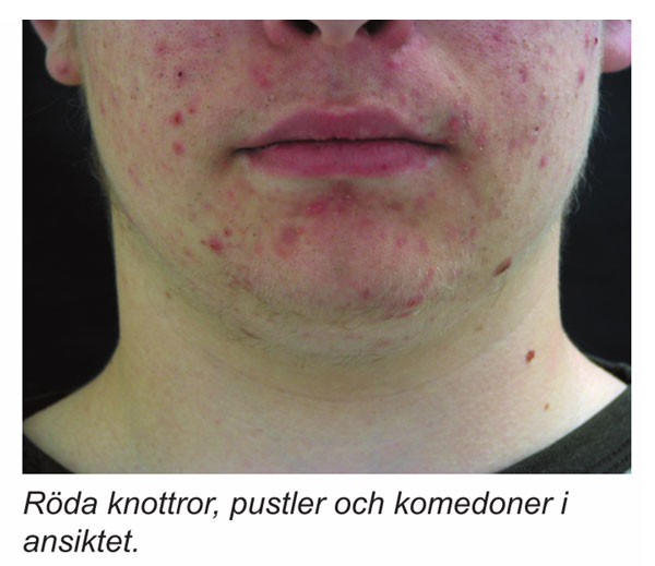 Bild på Acne, Rocasea och Perioraldermatit