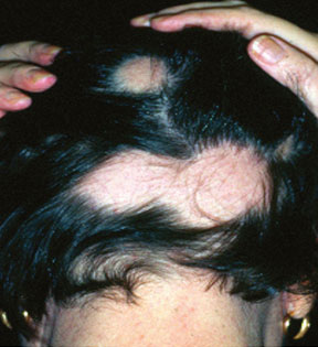Bild på Alopecia areata